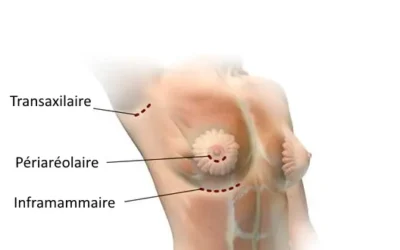 Augmentation mammaire l’incision