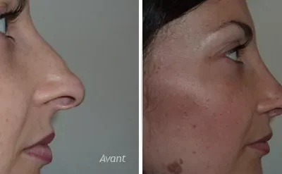 Rhinoplastie de révision