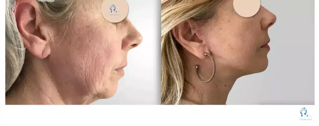 lifting du visage en tunisie estetika, Liposuccion du visage prix en france