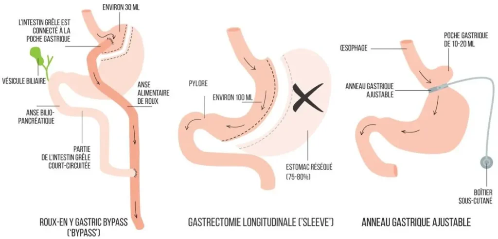 bypass, sleeve prix, anneau gastrique tunisie, chirurgie bariatrique