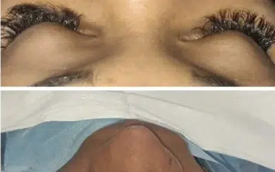 Rhinoplastie ethnique tunisie prix