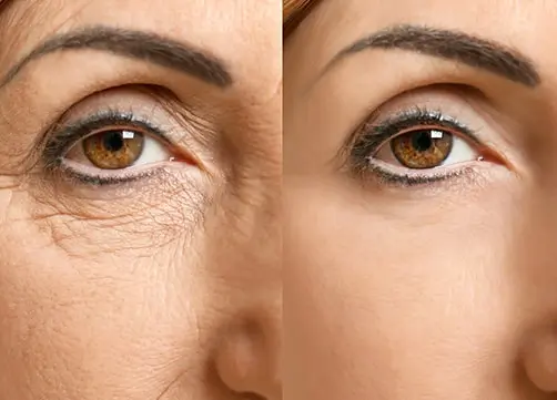 blepharoplastie avant après, Meilleur chirurgien blépharoplastie