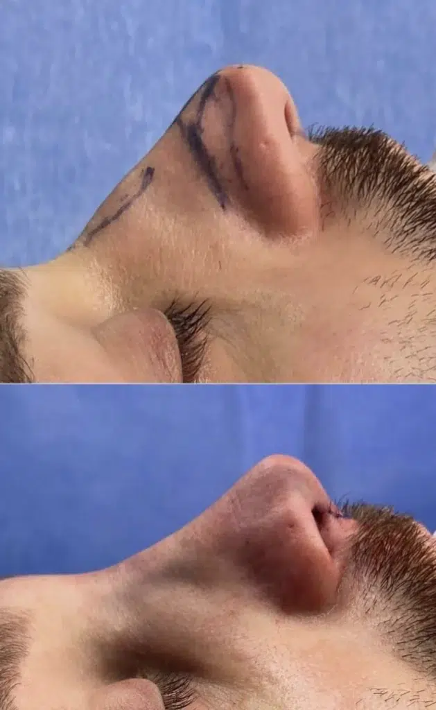 Photos avant après rhinoplastie homme bosse et pointe du nez