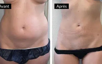 Quel âge pour une liposuccion ?