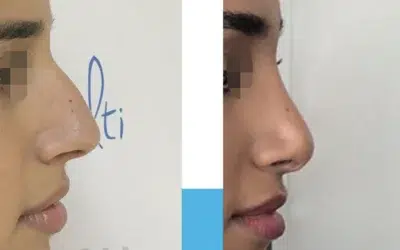 rhinoplastie après 1 mois