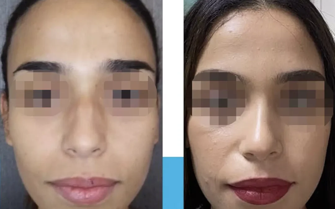 rhinoplastie ethnique avant après, Quel est le prix d'une chirurgie esthétique du nez ?