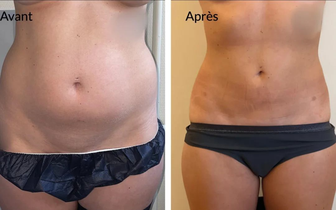 Combien coute liposuccion du ventre​