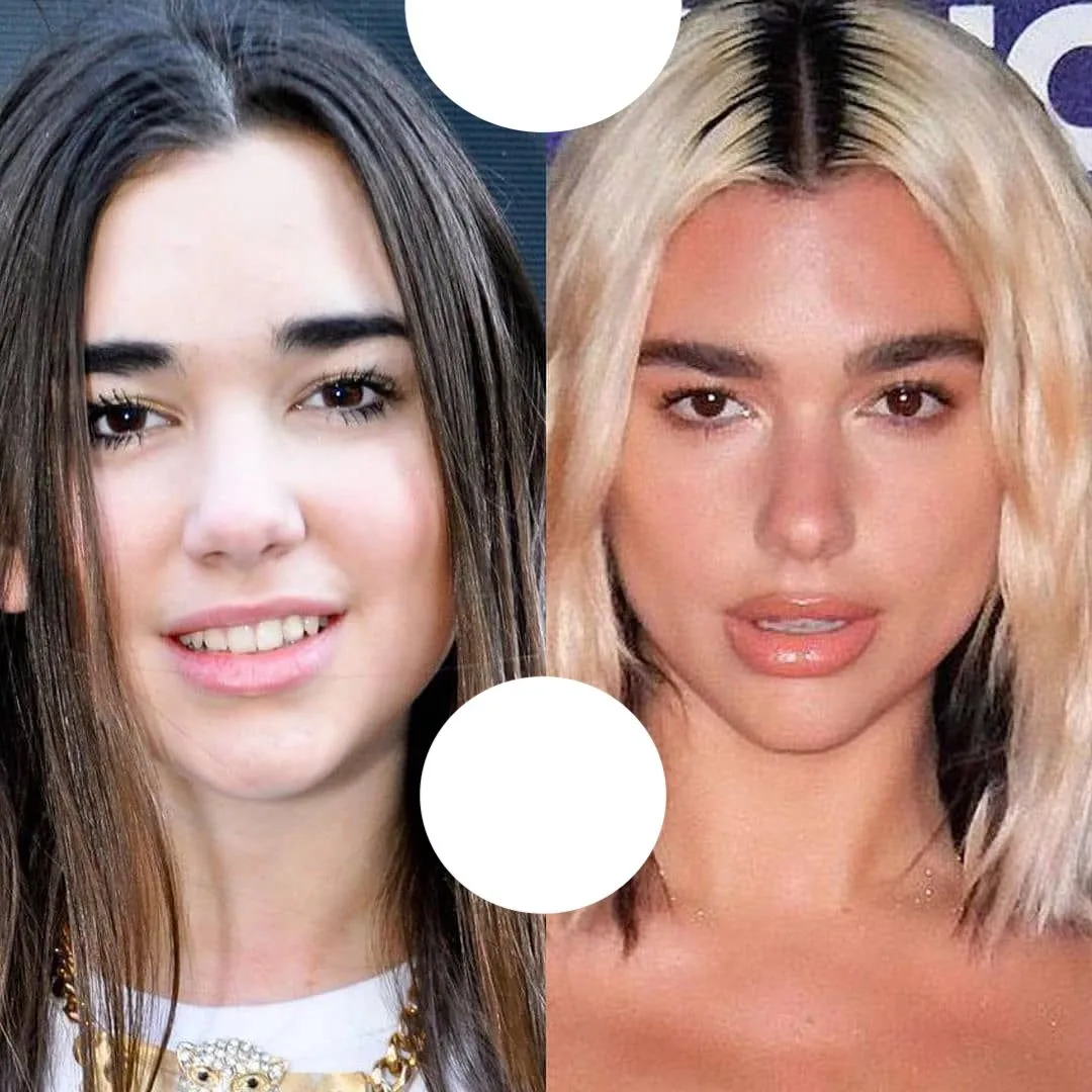 Dua Lipa Chirurgie | Visage, Nez, Poitrine | Stars | 2024