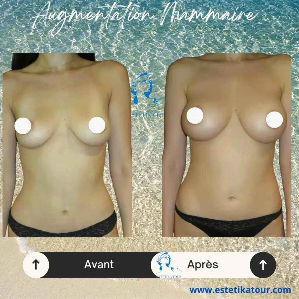 Tarif augmentation mammaire tunisie, Augmentation mammaire en tunisie, Comment faire grossir sa poitrine ?, Gros seins au naturel, Prix augmentation mammaire tunisie