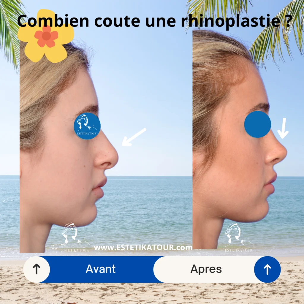 Combien coute une rhinoplastie ? , Quel est le prix d'une rhinoplastie en Tunisie, Quel est le prix pour refaire le nez ? rhinoplastie pointe du nez avant apres