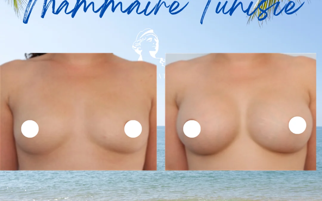 Augmentation mammaire ratée tunisie