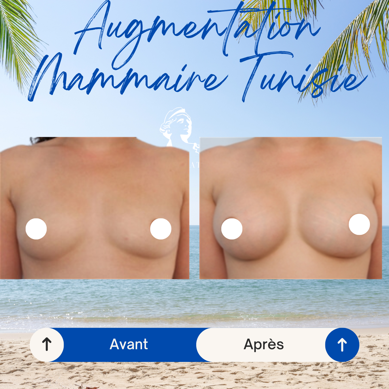 Implant mammaire prix france, Augmentation mammaire ratée tunisie