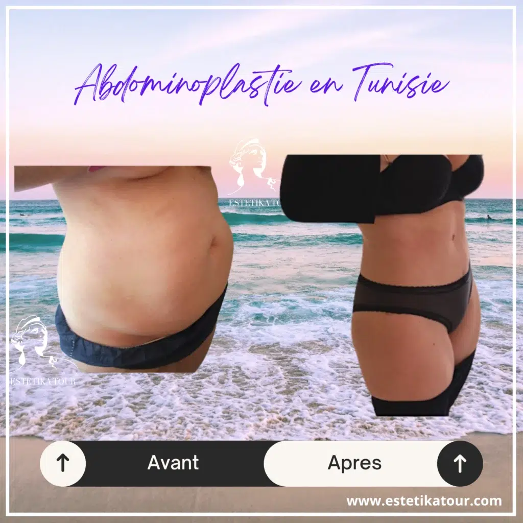 Prix abdominoplastie pas cher tunisie, abdominoplastie tunisie, Quel est le prix d'une abdominoplastie en Tunisie ? , Prix abdominoplastie tunisie