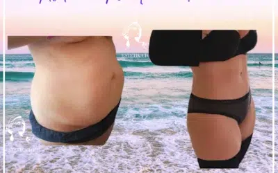 Prix abdominoplastie ou Plastie Abdominale