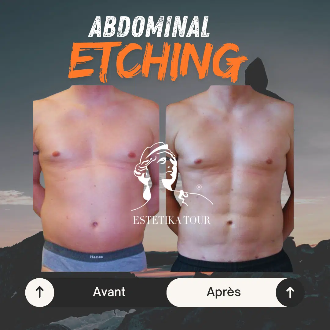 Abdominal etching homme 50 ans
