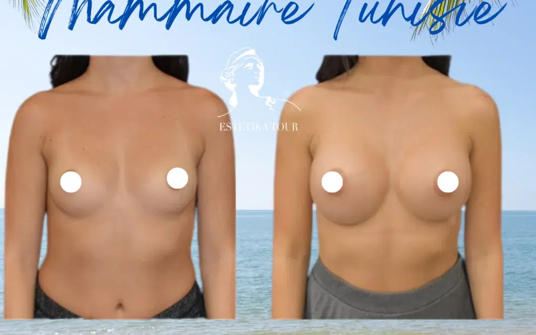 Augmentation mammaire tunisie prix