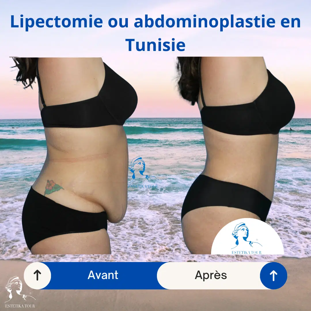 Liposuccion douce, Liposuccion en tunisie avis