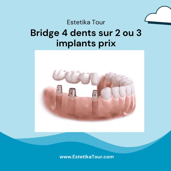 Bridge 4 dents sur 2 implants prix