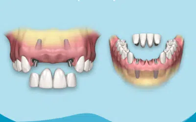 Bridge 4 dents sur 2 implants prix