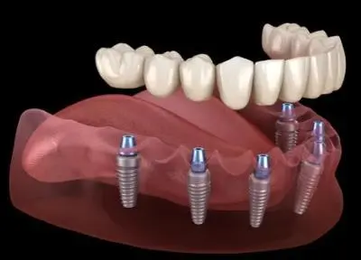 Bridge complet en céramique sur 6 implants