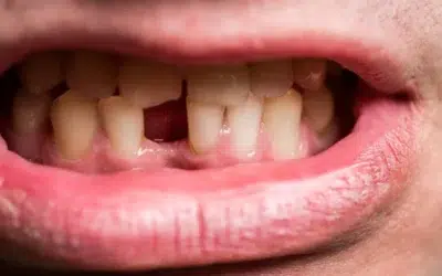 Dent provisoire avant implant prix