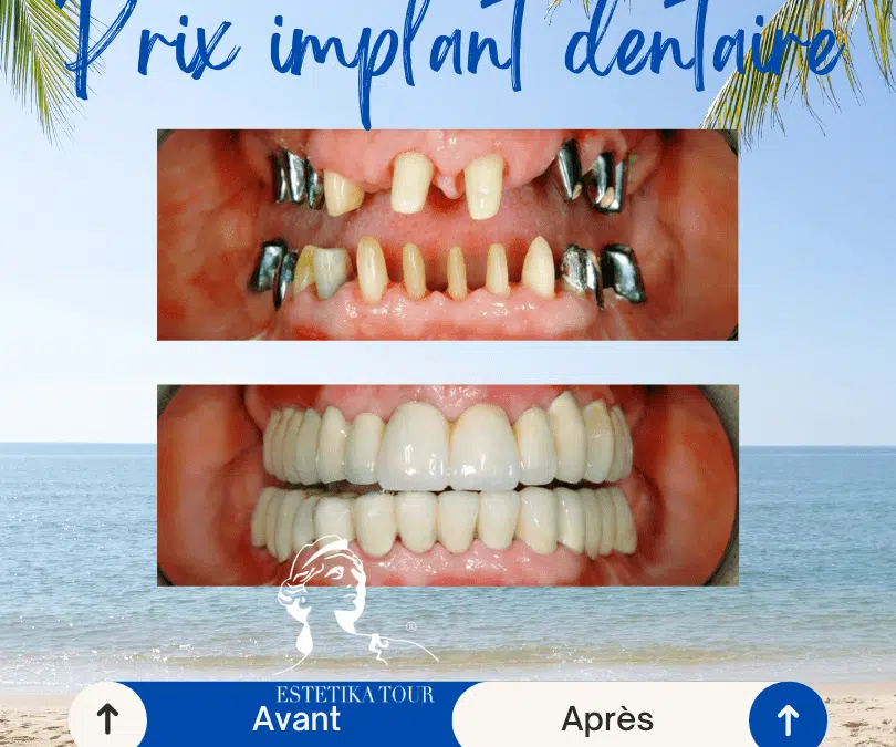 Prix implant dentaire