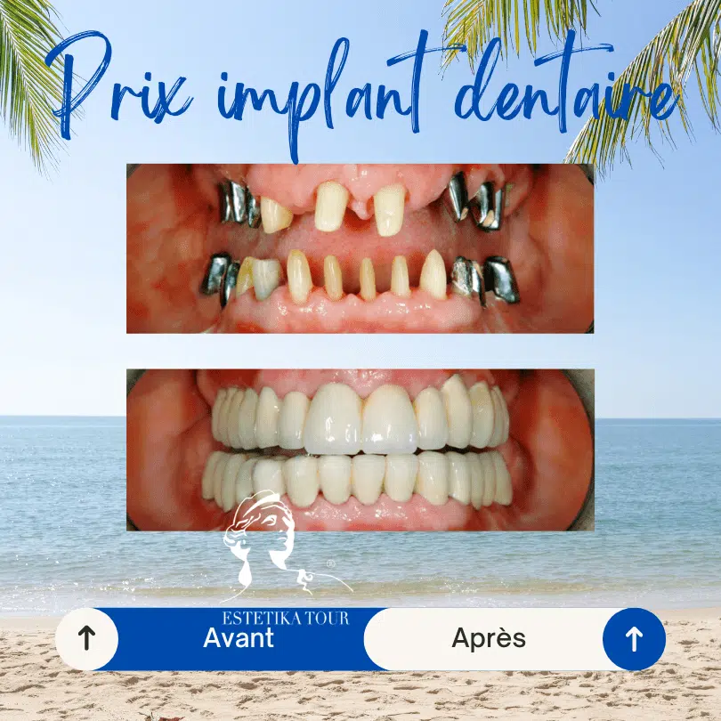 Prothèse dentaire sur implant prix