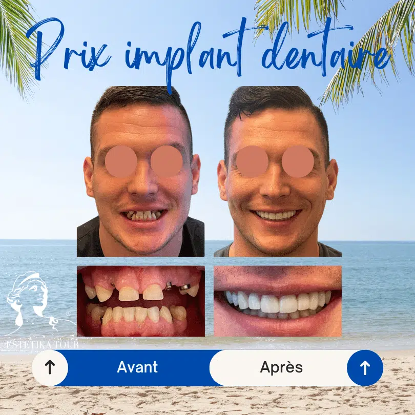 Prix implant dentaire