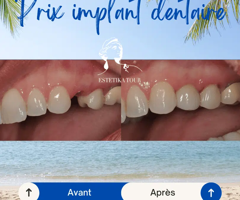 Implants dentaire tunisie prix