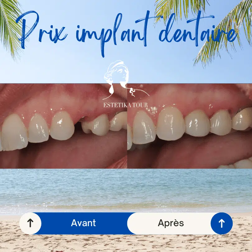 Prix implant dentaire