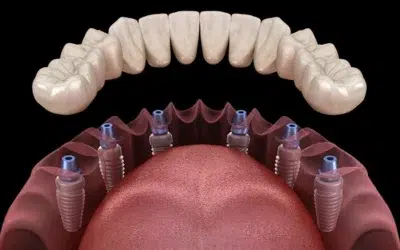 Prothèse dentaire sur implant prix