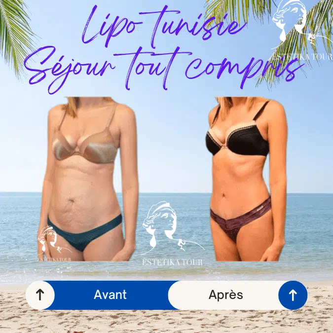 Lipo tunisie, liposuccion tunisie