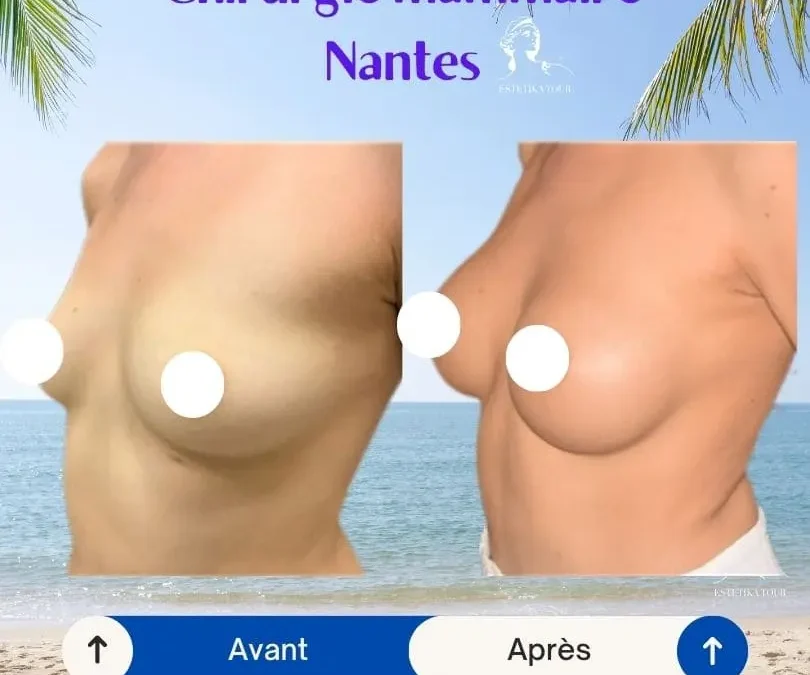 Chirurgie mammaire Nantes, chirurgie esthétique nantes tarifs​, Augmentation mammaire prix nantes