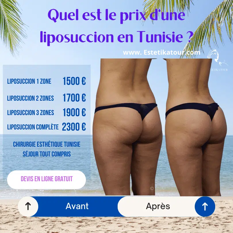 Quel est le prix d'une liposuccion en Tunisie ?, liposuccion ventre lyon