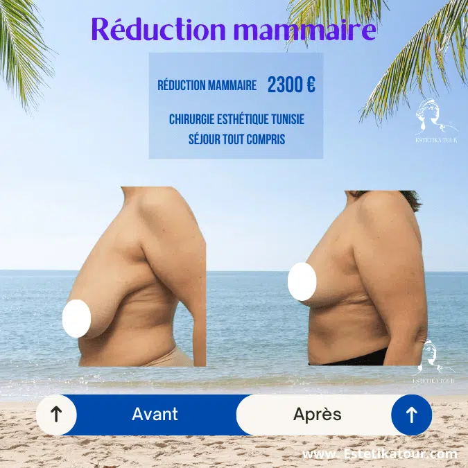 Réduction mammaire, Prix pour une reduction mammaire, Gros sein femme, Réduction mammaire prix