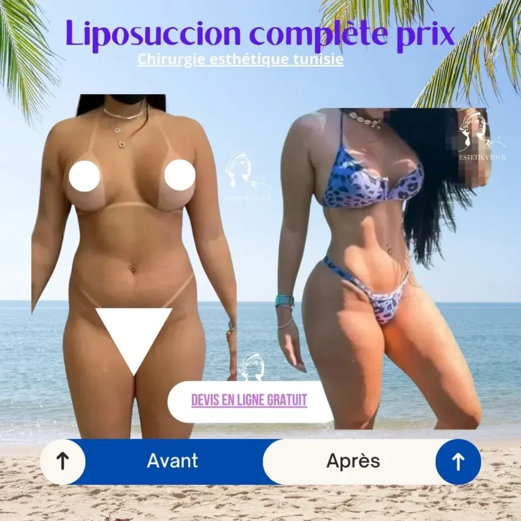 Liposuccion complète prix, apres liposuccion, Lipossucion hanche tunisie