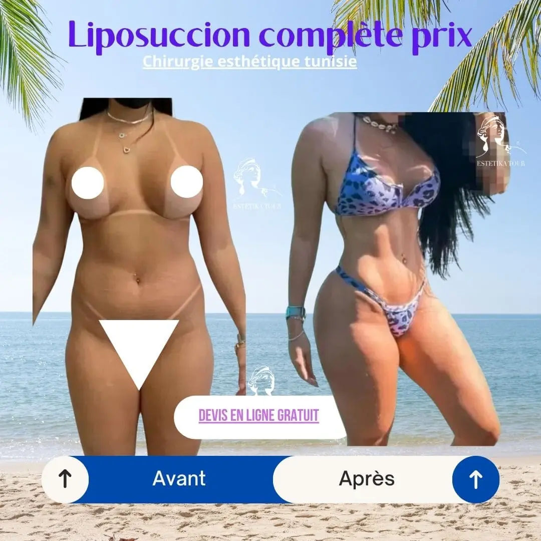 Liposuccion complète prix