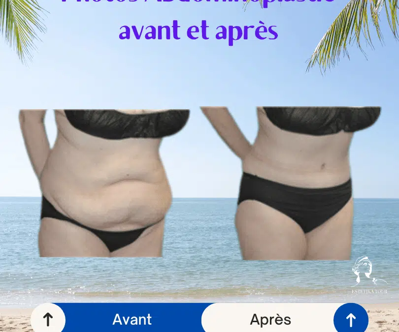 abdominoplastie avant et après, Bienfaits médicaux de l'abdominoplastie