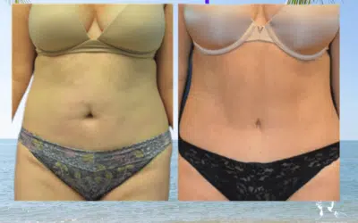 Abdominoplastie apres 1 mois Devis gratuit