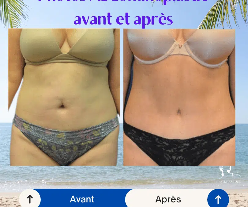 Abdominoplastie apres 1 mois Devis gratuit