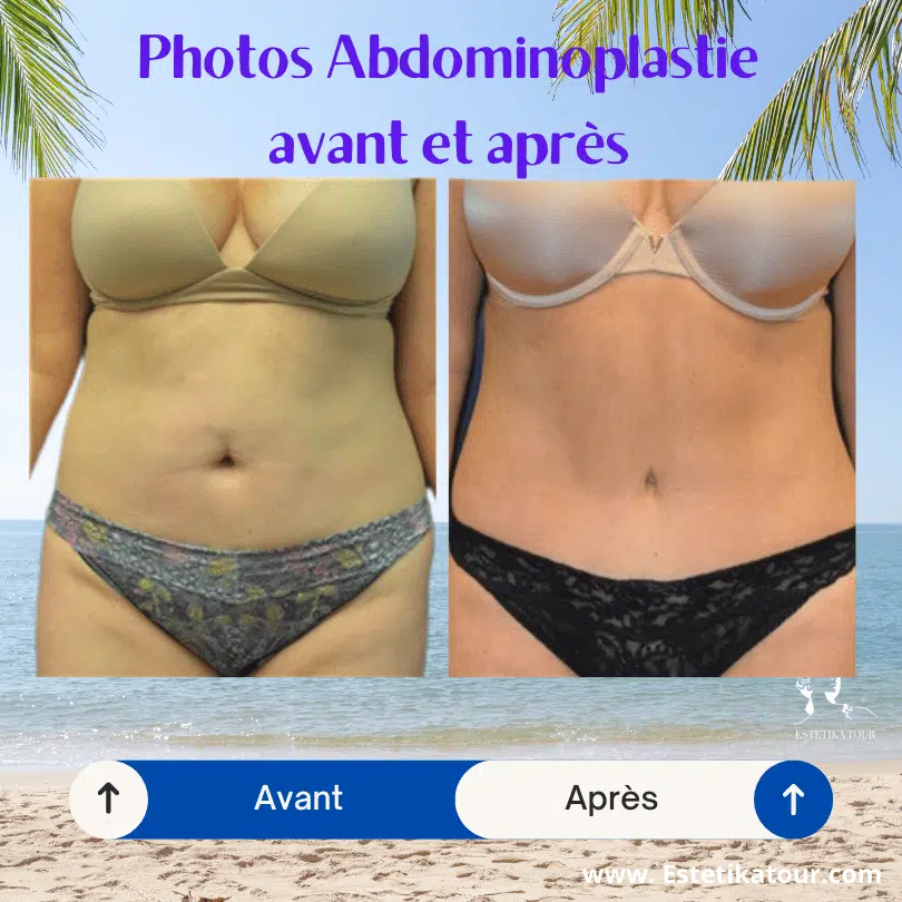 abdominoplastie avant et après