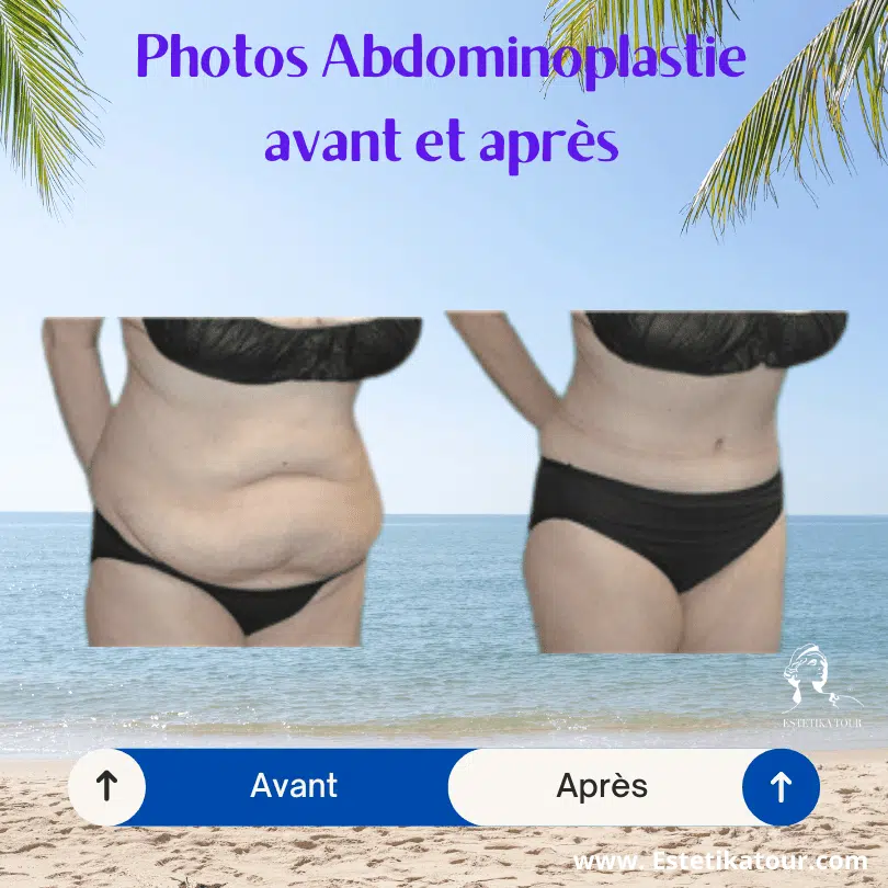 abdominoplastie avant et après