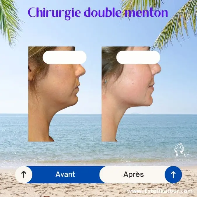 Chirurgie double menton