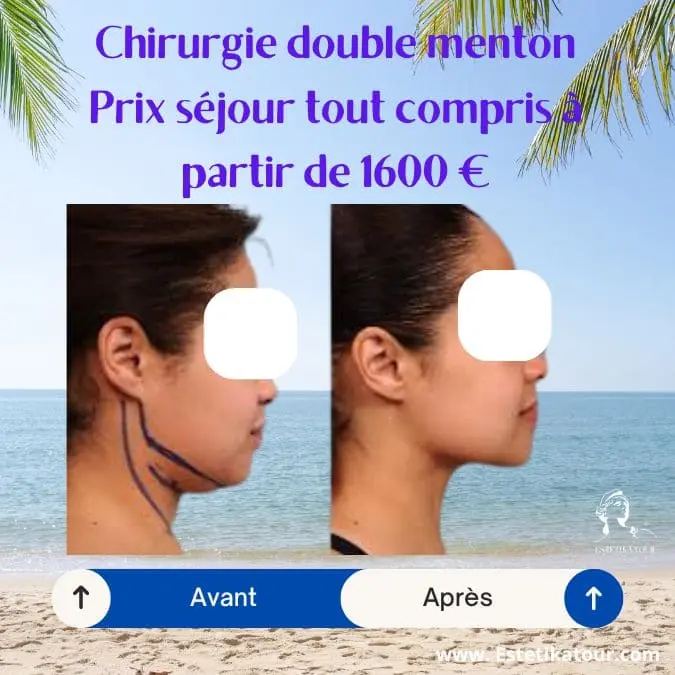 Chirurgie double menton prix