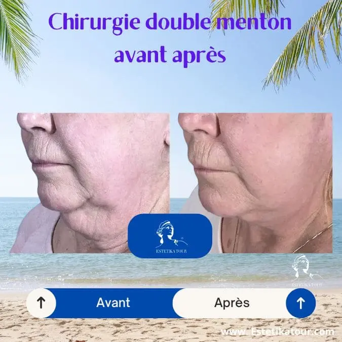 Chirurgie double menton