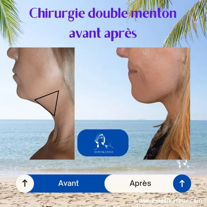 Chirurgie double menton