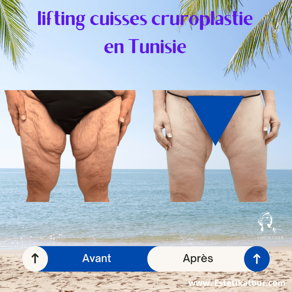 Lifting cuisses cruroplastie prix