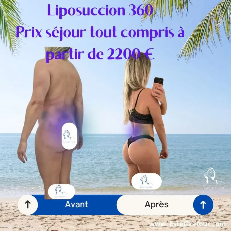 Liposuccion 360 prix, liposculpture tarif, Liposuccion complète