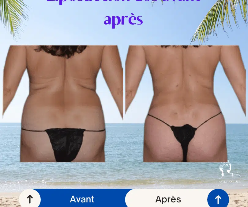 Liposuccion dos avant après, bourrelet dans le dos