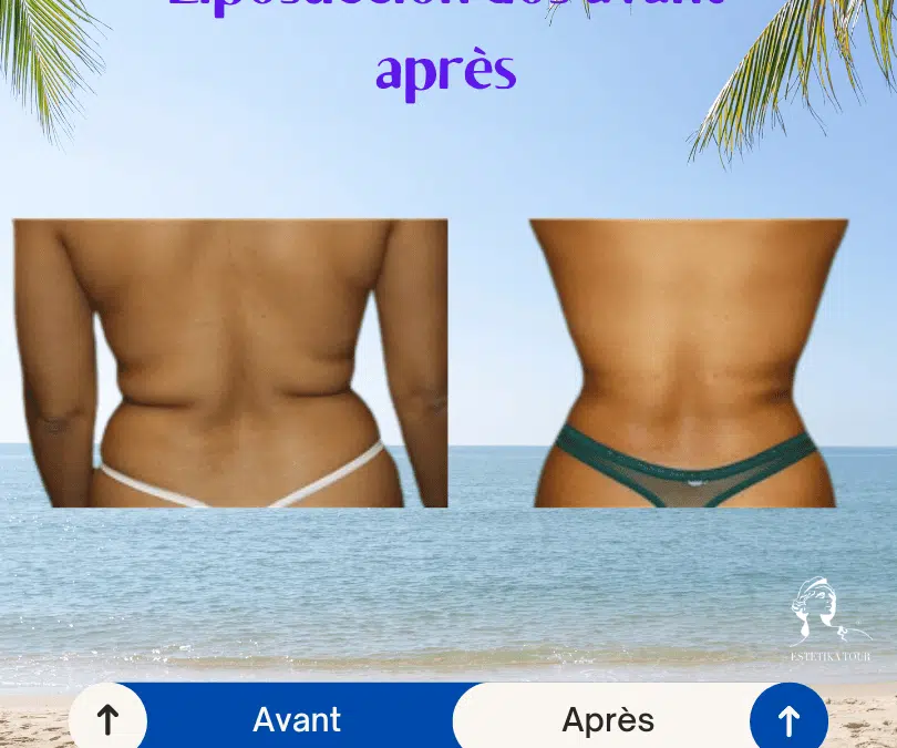 Liposuccion dos avant après